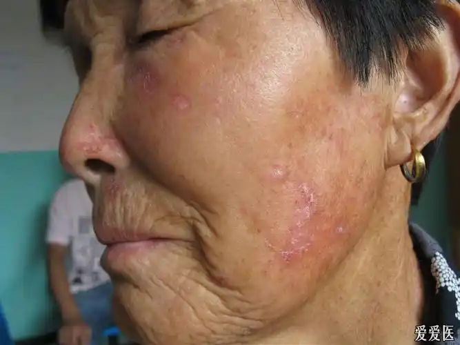 看图识病--------盘状红斑狼疮