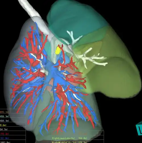 三维影像重建黑科技聊城市三院让肺小结节切除更精准