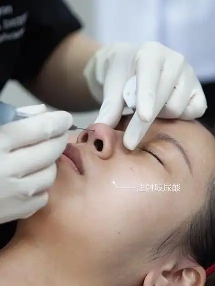 玻尿酸隆鼻效果好不好鼻子说了算