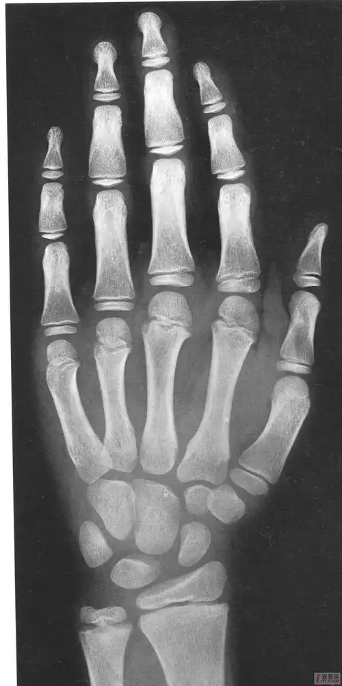 中国儿童标准骨龄片