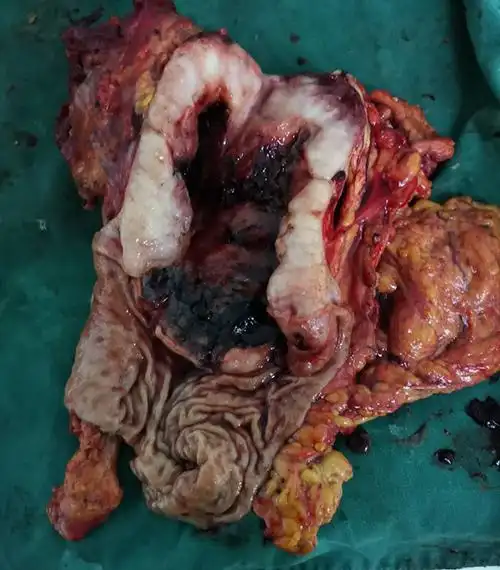 巨大癌灶及转移灶的晚期胃癌出血急诊手术救治成功