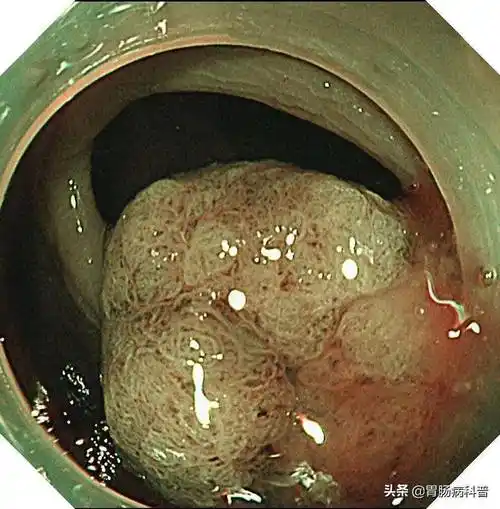 一文读懂肠息肉——为啥会长肠息肉?严重吗?如何治疗?怎样预防_肠道_