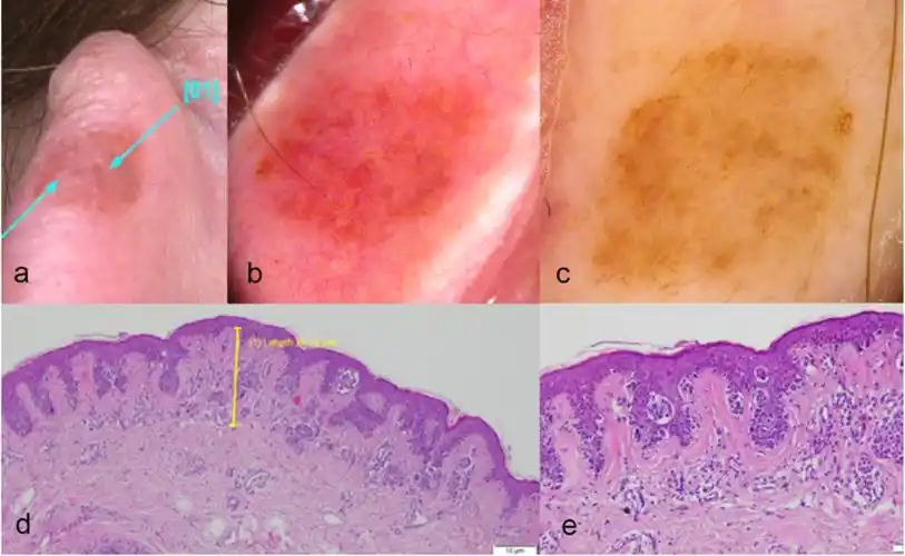 外耳黑色素瘤的皮肤镜表现_医学界-助力医生临床决策和职业成长