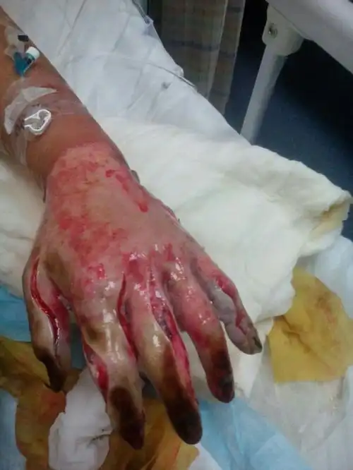 恳求各界爱心人士紧急援手救救我严重烧伤的父亲