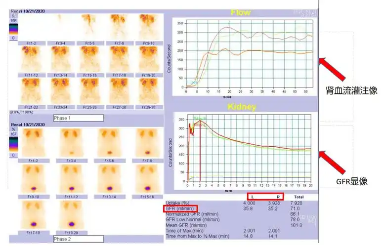 【小南话科普】肾脏功能检查"金标准"——核素肾小球滤过率显像_手机