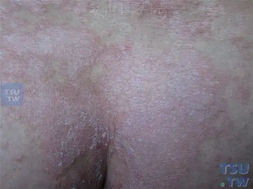 斑块型副银屑病parapsoriasisenplaques症状表现