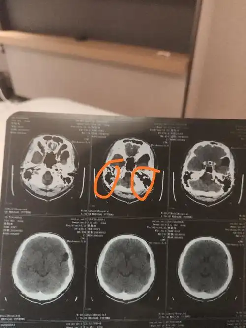 帮忙看下脑部ct图片有什么问题?