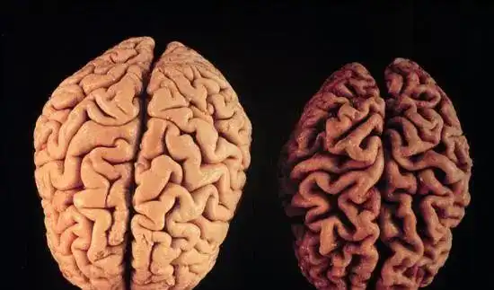 腹部越胖,越易脑萎缩,是真的吗?