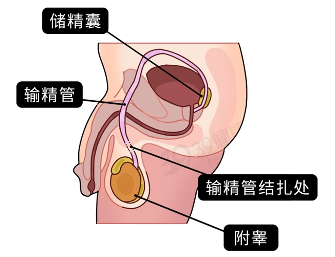 结扎会降低性能力?早知道早受益_精子_手术_输精管