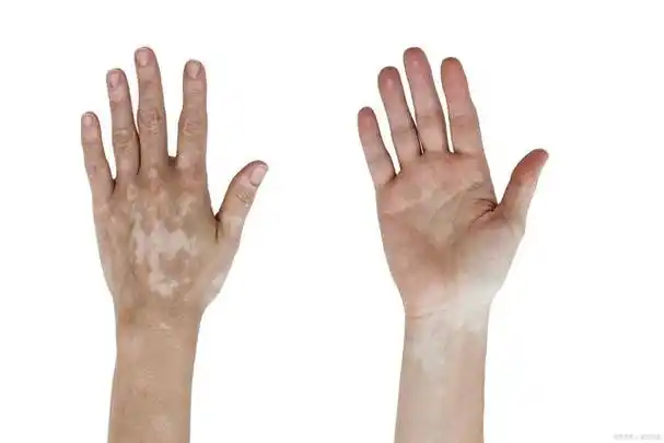 肢端型白癜风就是指白斑发生在手足部的白癜风,肢端型白斑在临床上
