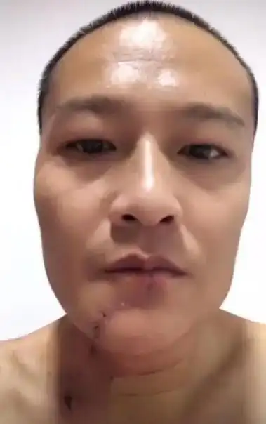 "槟榔四巨头":一天狂炫5包槟榔,两年死仨,剩下一个割舌保命