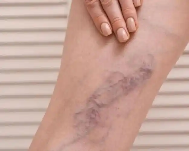 虽然腿部红血丝不一定是静脉曲张的表现,但它们的确可能是静脉功能不