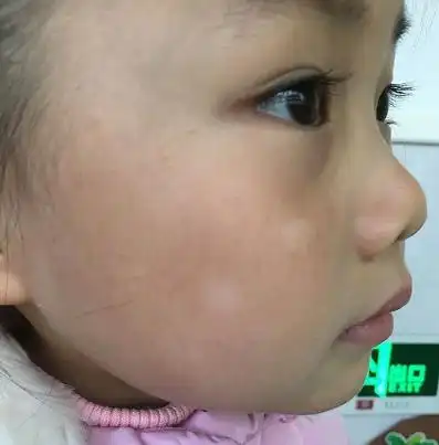 蛔虫脸上白斑图片50