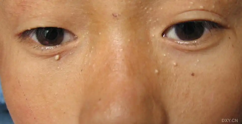 【请教】家族性粟丘疹 - 皮肤性病 - 专业医生社区,医学,药学,生命