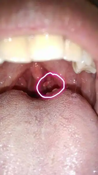 00:49 答: 此东西估计来自扁桃体,属于扁桃体乳头状瘤,可考虑先消消炎