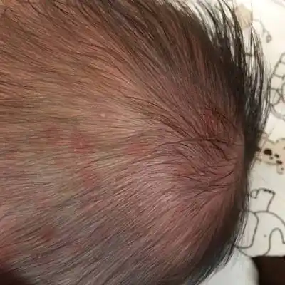 今天去医院看医生说是脓痱,昨天热出来的,多久会下啊,医生开的涂药和