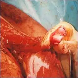 变性手术过程图示(男变女)