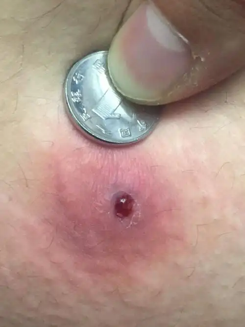 跪求医科大神…臀部起一包,伤口直径3.