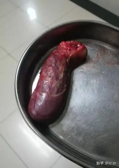 切除胆囊是一种怎样的感受?你后悔过吗? - 知乎