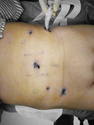 患者术后第1天就有肛门排气,第2天患者已下床活动,"我妈妈就好像做了