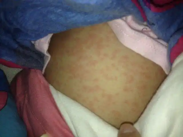 宝宝昨天下午发烧身上起了小红点 昨晚上退烧了 今天身上起了这个?