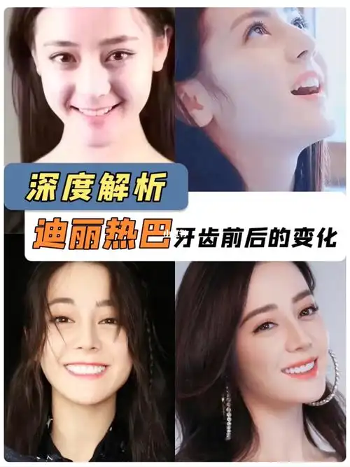 迪丽热巴牙齿前后的变化深度解析