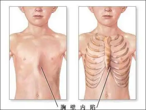 但是,生活中漏斗胸的患者也确实存在.其中就包括小儿漏斗胸.