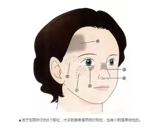 褐青斑和黄褐斑的区别?jpg