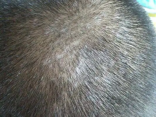 头皮癣图片 (52)