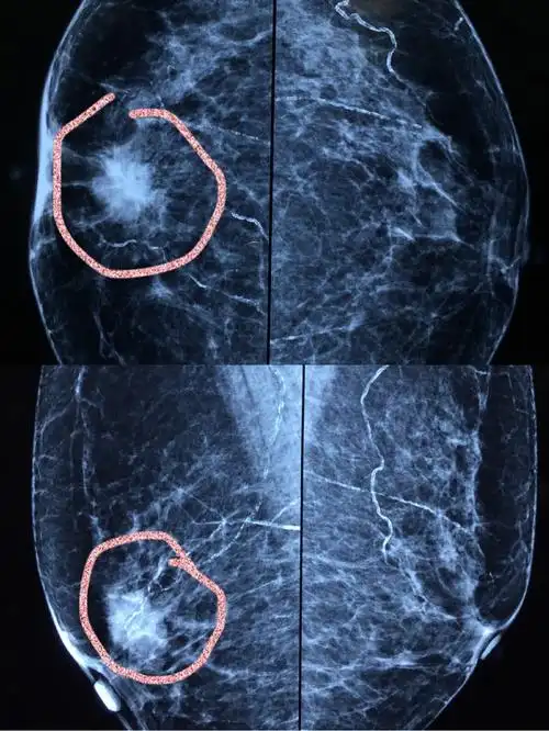 因发现右乳肿块一月入院,术前钼靶及彩色b超均呈典型的乳腺癌表现