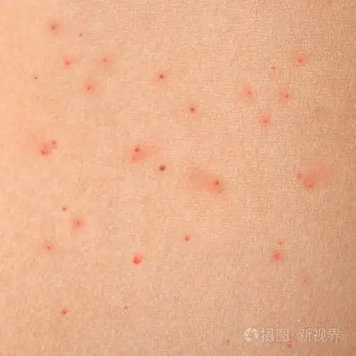 纹理的皮肤,红色的丘疹