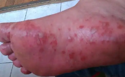 手足口的症状是什么