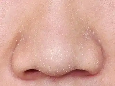 赶走黑头粉刺 皮肤亮光光_美容护肤知识大全_百度攻略