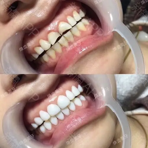 牙贴面 超瓷贴面 牙齿美白完成✅南京来的宝宝 说我_圈子-新氧美容