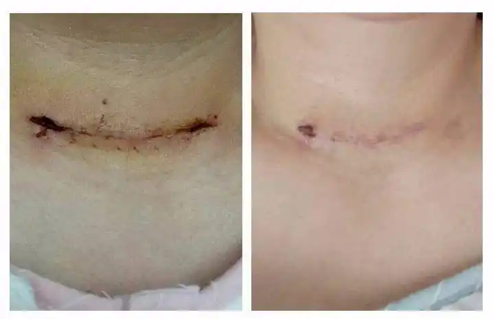 如果伤口难愈合,这是你最好的选择