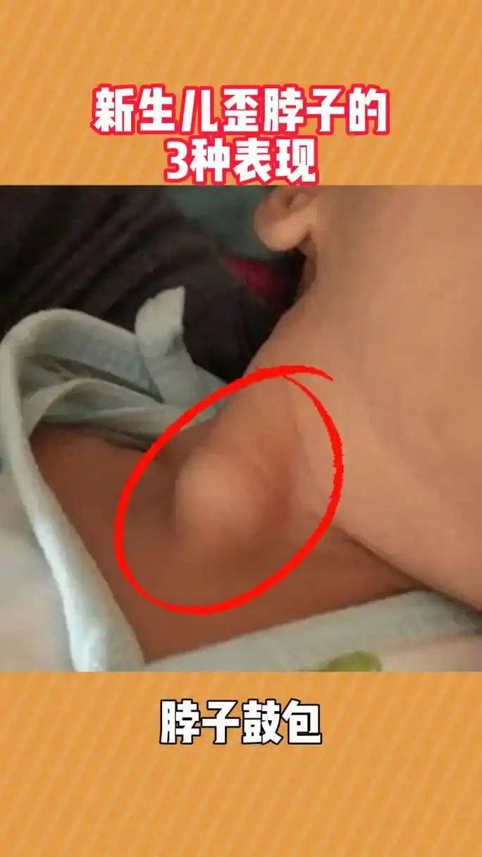 新生儿斜颈的三大表现   11566轻轻触摸宝宝脖子,能摸到硬硬的