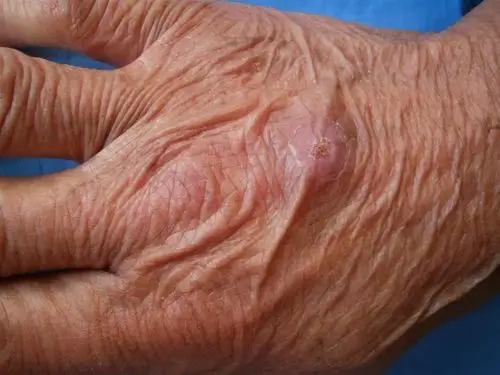 最近就诊的多例孢子丝菌病.