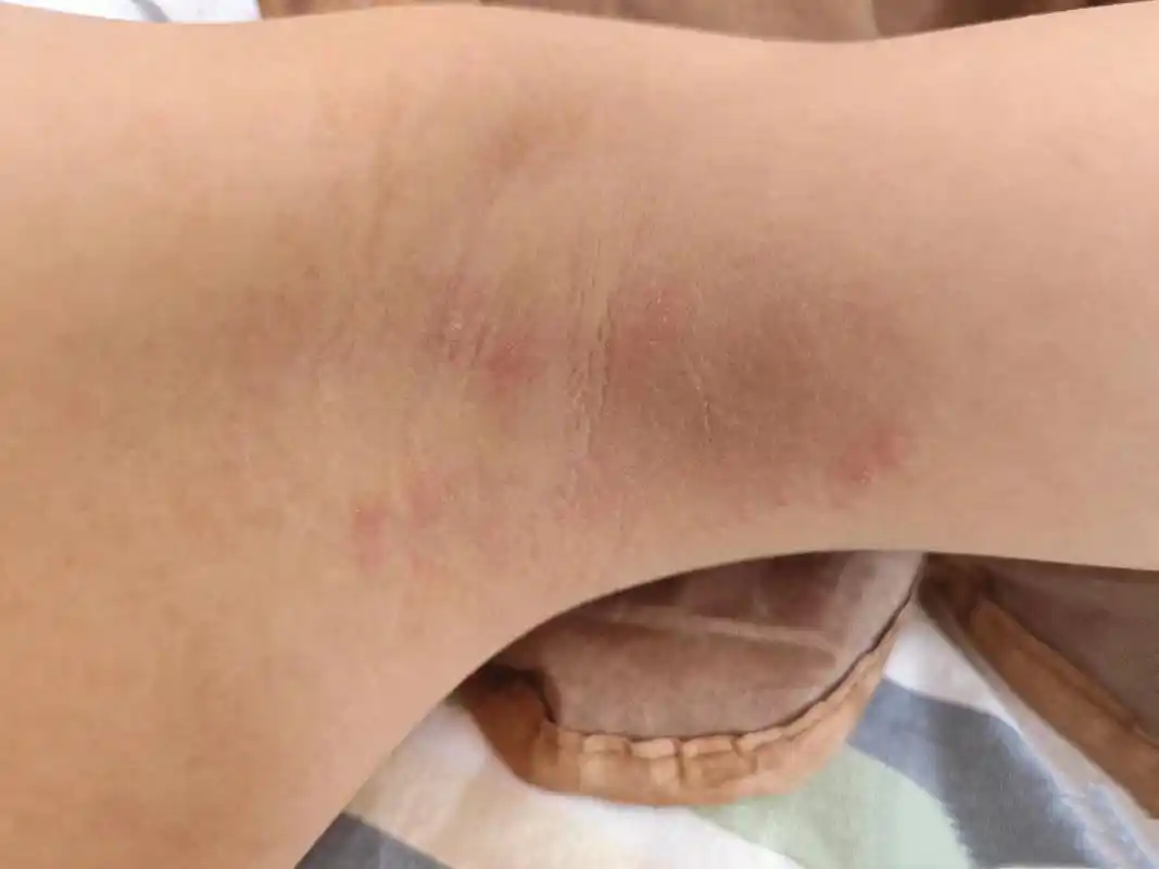 腋下脱毛会引起狐臭吗,腋下泛红是狐臭来临的表现吗