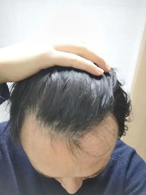 这个m型发际线严重吗