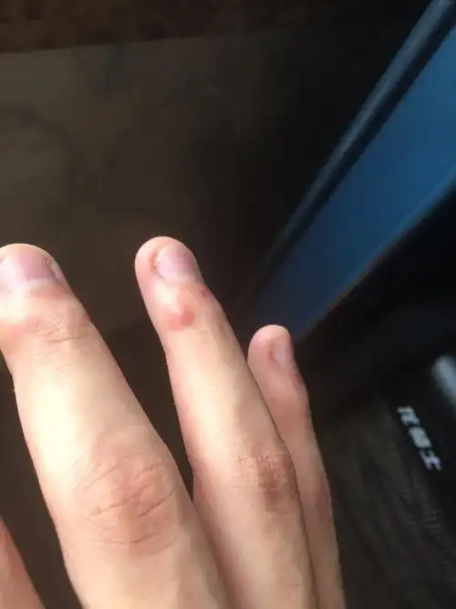 手指上起了个包,一个月了,这是什么,怎么办?