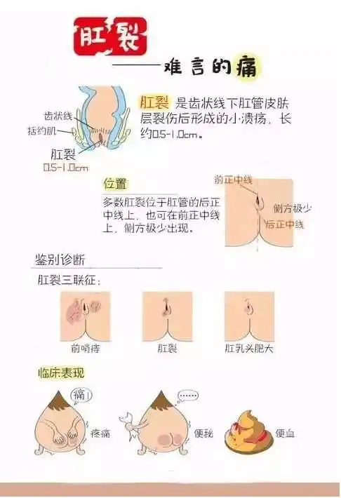 肛裂有哪些症状及危害
