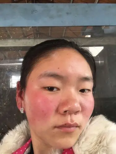 脸动不动就红,还很烫人,这是为啥?