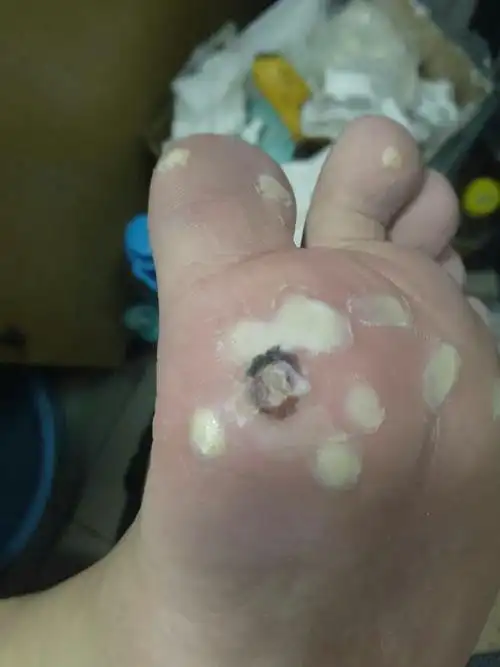 跖疣冷冻14天了,大的周围全黑,前几天有黑色液体流出,小的之前起了