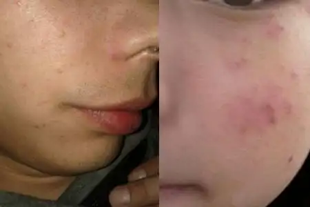 粉刺和螨虫的区别图片一分教你轻松辨别