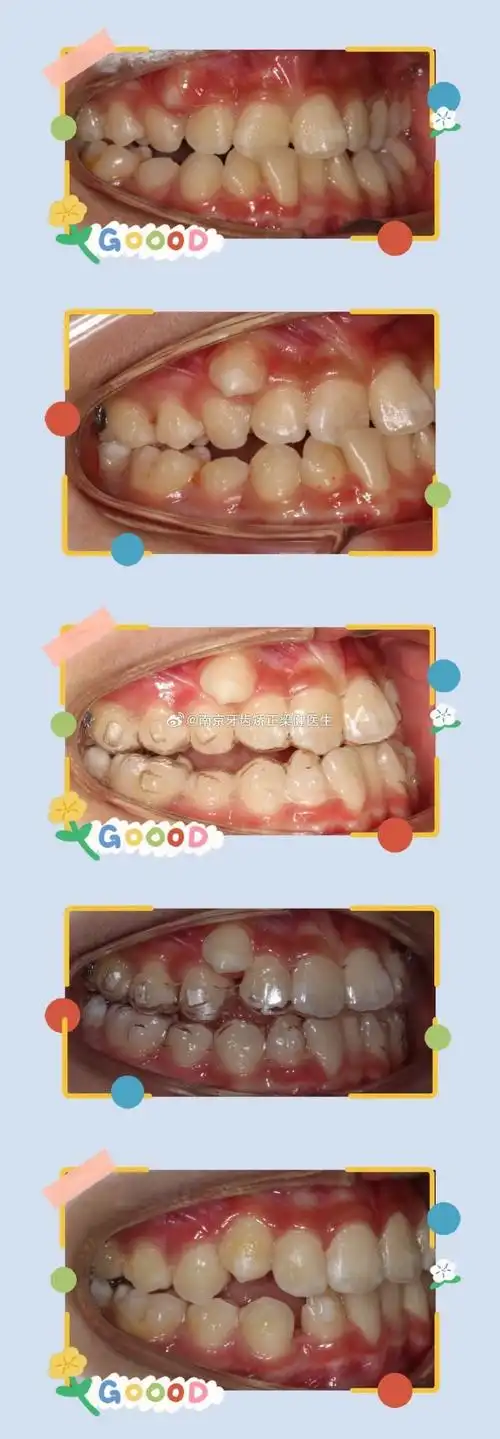 929292上颌尖牙是除第三磨牙外最易阻生的恒牙,患病率为1%-3%