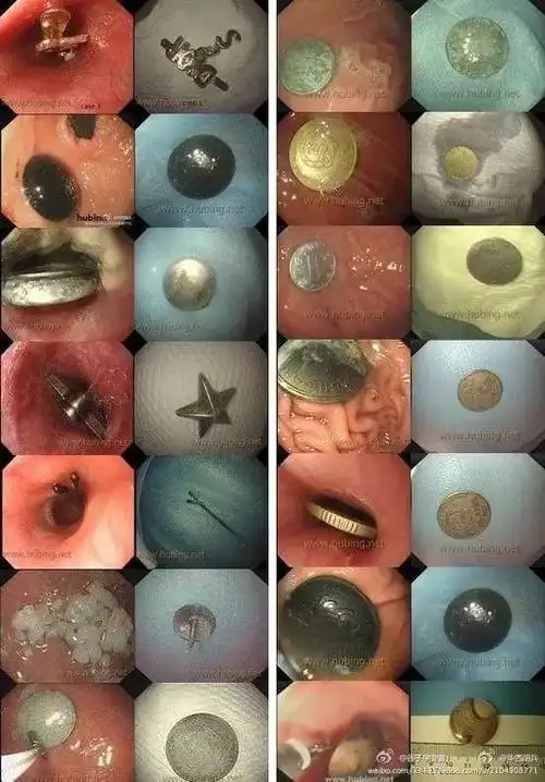 误吞电池10余小时 小男孩食道被烧烂了!