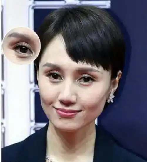 眼睛凹陷才是真毁容从杨幂到陶虹多少女神被害惨