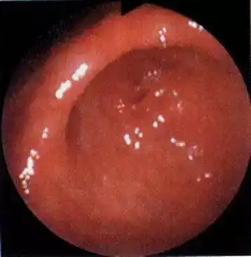 慢性非萎缩性胃炎