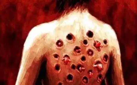 玉米男孩原型事件,体内长密集寄生虫用手扣虫子