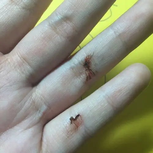 拍死一只蚊子 蚊子的血都弄在手上了 手上有伤口 会不会感染艾滋病